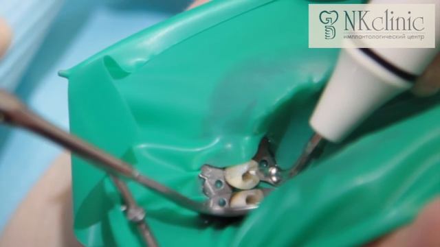 Лечение зуба под микроскопом в NKclinic