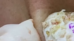 #268 Чистка лица от угрей и акне. Выдавливание прыщей. Удаление черных точек и комедонов