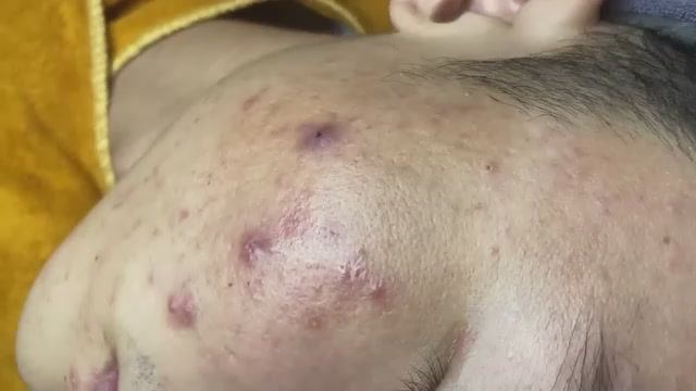 074 • Acne Collection • АСМР • Relax Spa