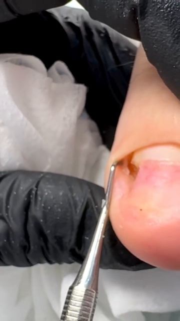 Как вылечить грибок?