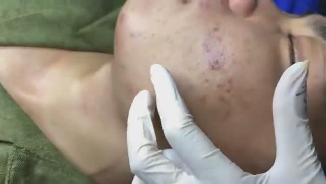 Глубокие скрытые прыщи под кожей. Часть 2