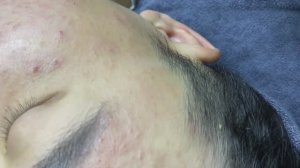 086 • Acne collection • АСМР • Relax Spa