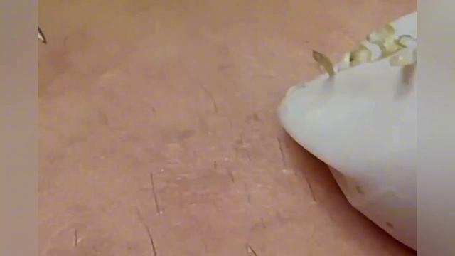 Выдавливание прыщей, угрей, черных точек и камедонов #368