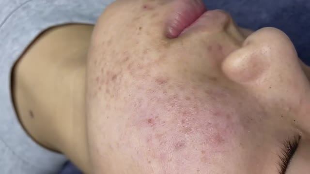 083 • Acne Collection • АСМР • Relax Spa