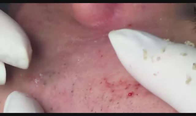 ASMR: услуга по лечению акне — расслабление и чистота