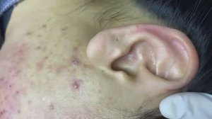 085 • Acne collection • АСМР • Relax Spa