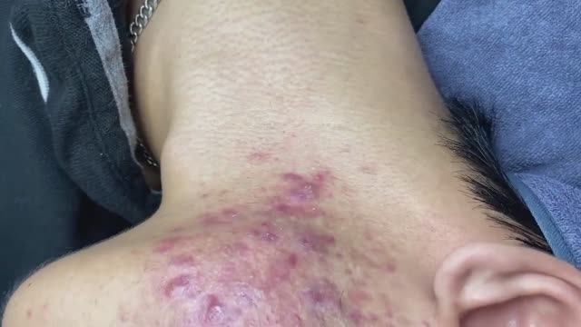 081 • Acne Collection • АСМР • Relax Spa