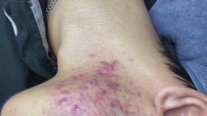 081 • Acne collection • АСМР • Relax Spa