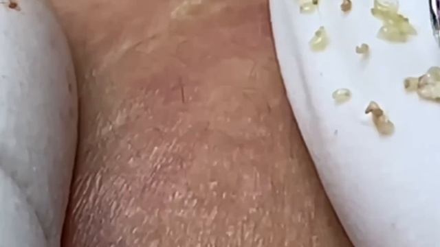 #271 Чистка лица от угрей и акне. Выдавливание прыщей. Удаление черных точек и комедонов