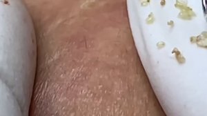 #271 Чистка лица от угрей и акне. Выдавливание прыщей. Удаление черных точек и комедонов