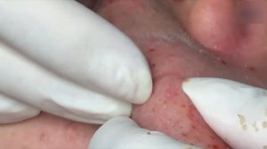 ASMR: услуга по лечению акне — расслабление и чистота