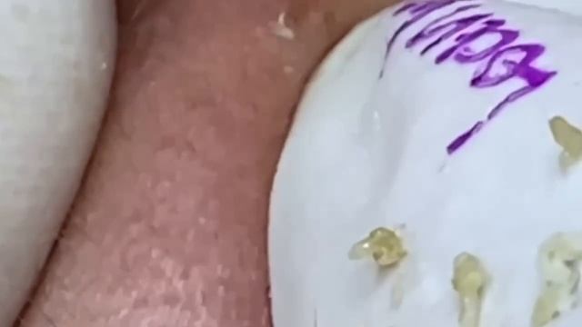 #273 Чистка лица от угрей и акне. Выдавливание прыщей. Удаление черных точек и комедонов