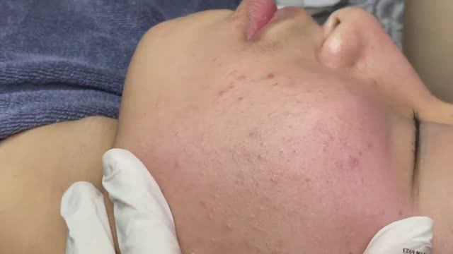 082 • Acne Collection • АСМР • Relax Spa