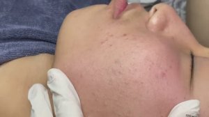 082 • Acne collection • АСМР • Relax Spa