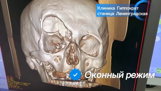 Зачем делать КТ при переломе? Современная диагностика в МЦ «Гиппократ» | ст. Ленинградская