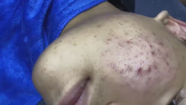 080 • Acne Collection • АСМР • Relax Spa