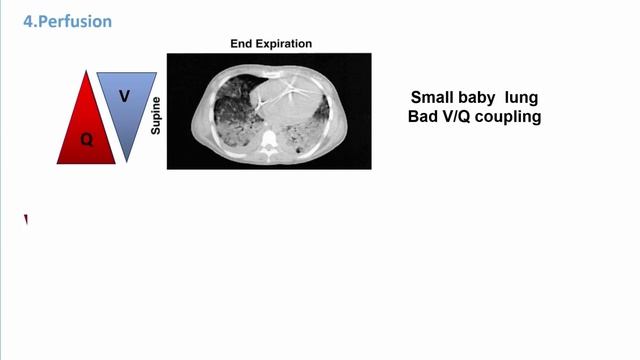 Prone Positioning Francesca Collino ISCEM 45