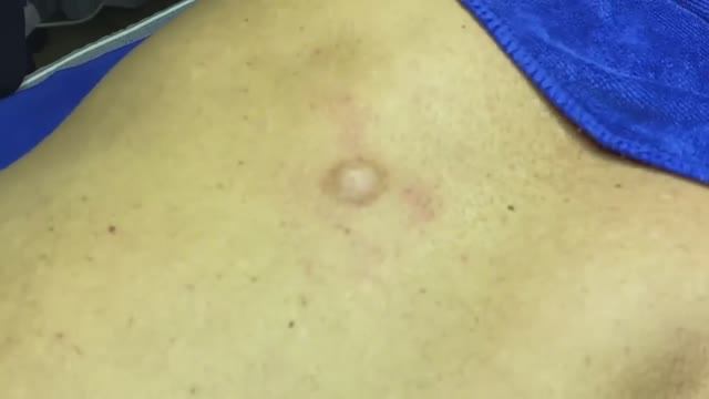 087 • Acne collection • АСМР • Relax Spa