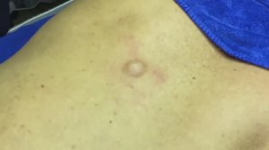 087 • Acne collection • АСМР • Relax Spa