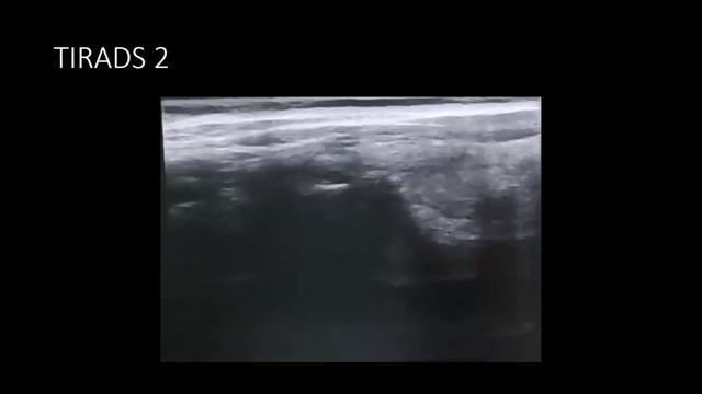 ЩЖ. Обзор коротких видео (TIRADS 2)