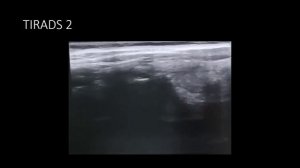 ЩЖ. Обзор коротких видео (TIRADS 2)