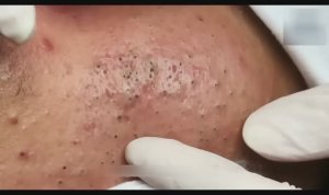 55 минут профессионального удаления черных точек — полный процесс