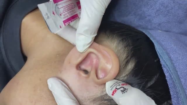 077 • Acne Collection • АСМР • Relax Spa