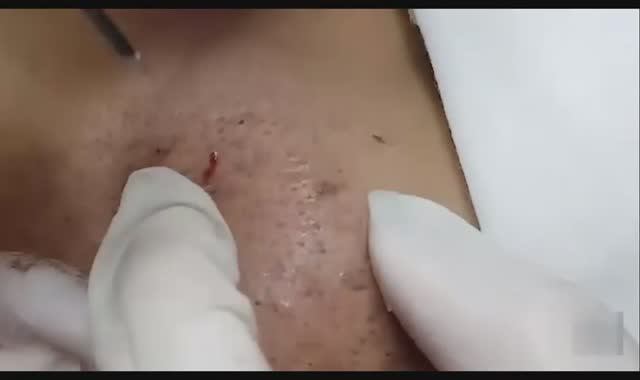 Удаление подкожных прыщей и черных точек