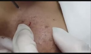 Удаление подкожных прыщей и черных точек