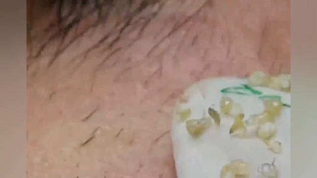 Выдавливание прыщей, угрей, черных точек и камедонов #369