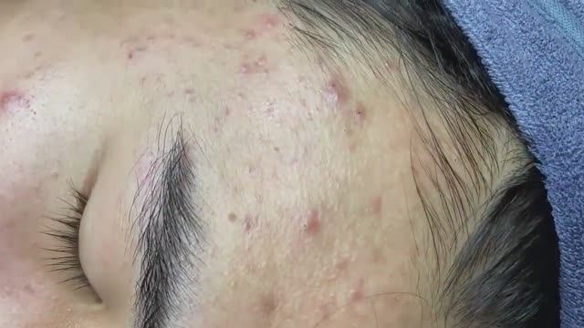 079 • Acne Collection • АСМР • Relax Spa