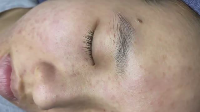 078 • Acne Collection • АСМР • Relax Spa