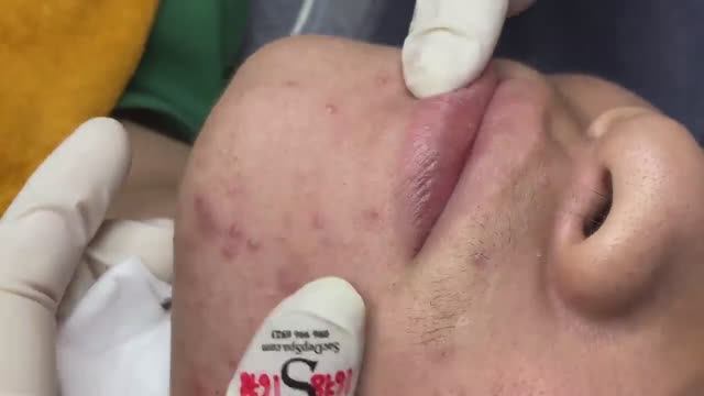 084 • Acne collection • АСМР • Relax Spa