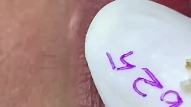 #272 Чистка лица от угрей и акне. Выдавливание прыщей. Удаление черных точек и комедонов