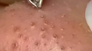 #274 Чистка лица от угрей и акне. Выдавливание прыщей. Удаление черных точек и комедонов