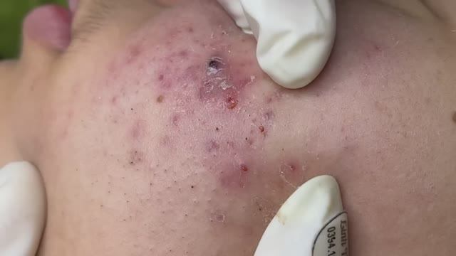 Выдавливание черных точек и прыщей