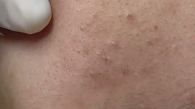 Удаление глубоких подкожных акне
