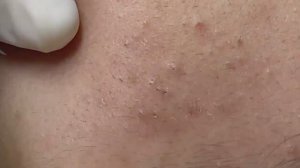 Удаление глубоких подкожных акне