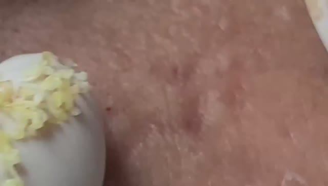 Удаление множественных комедонов и акне — тотальная очистка