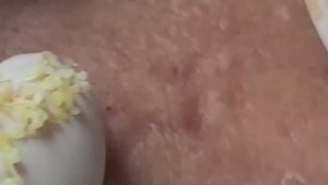 Удаление множественных комедонов и акне — тотальная очистка