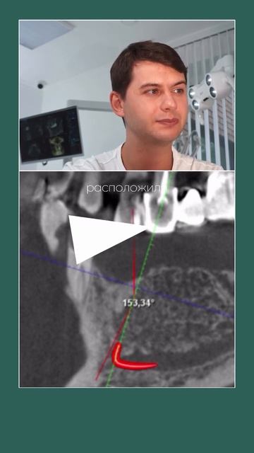 Деление шовного материала