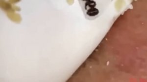 #275 Чистка лица от угрей и акне. Выдавливание прыщей. Удаление черных точек и комедонов