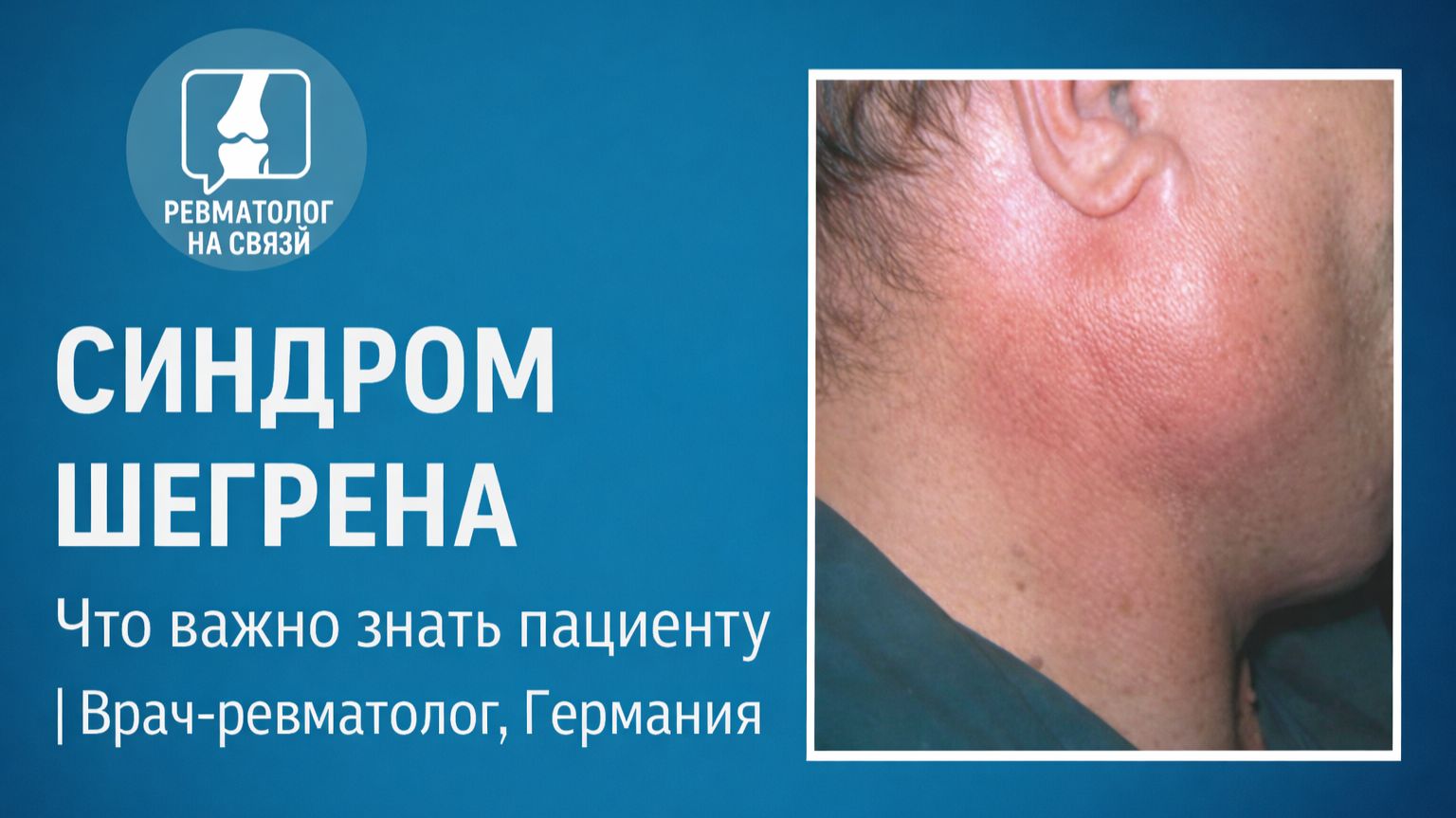 Синдром Шегрена: что скрывается за сухостью глаз и рта?