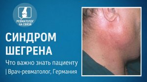 Синдром Шегрена: что скрывается за сухостью глаз и рта?