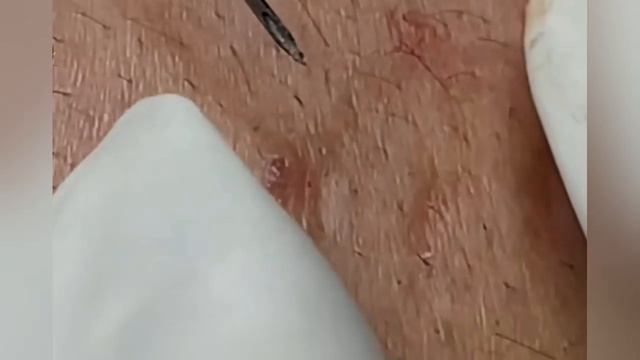 Выдавливание прыщей, угрей, черных точек и камедонов #372