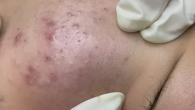 Удаление черных точек и прыщей на лице