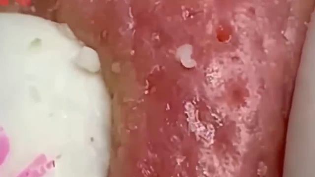 276 Чистка лица от угрей и акне. Выдавливание прыщей. Удаление черных точек и комедонов