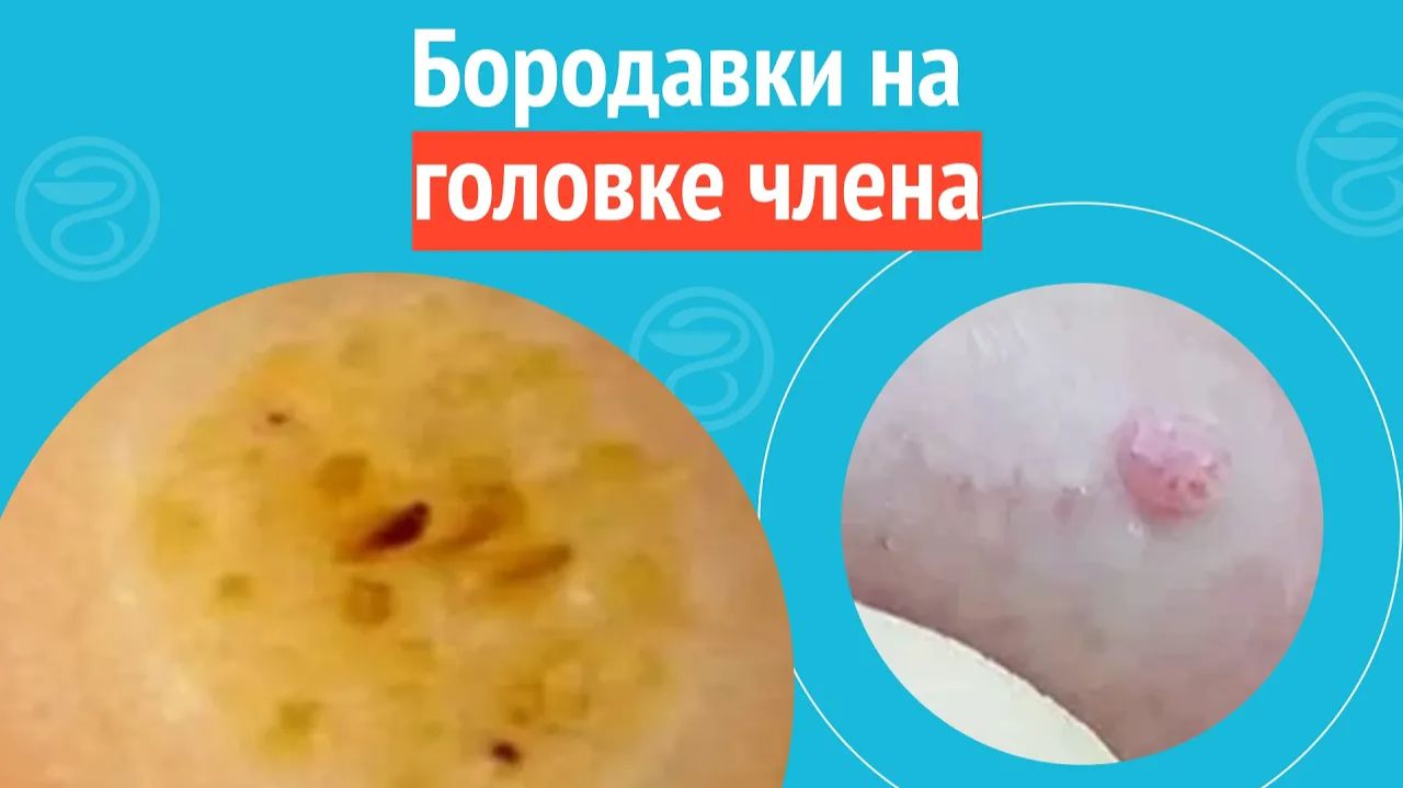 😮 Бородавки на головке члена. Клинический случай №1279