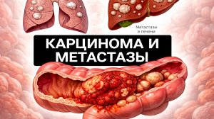 Адекарцинома сигмовидной кишки с метастазами в печени и легких