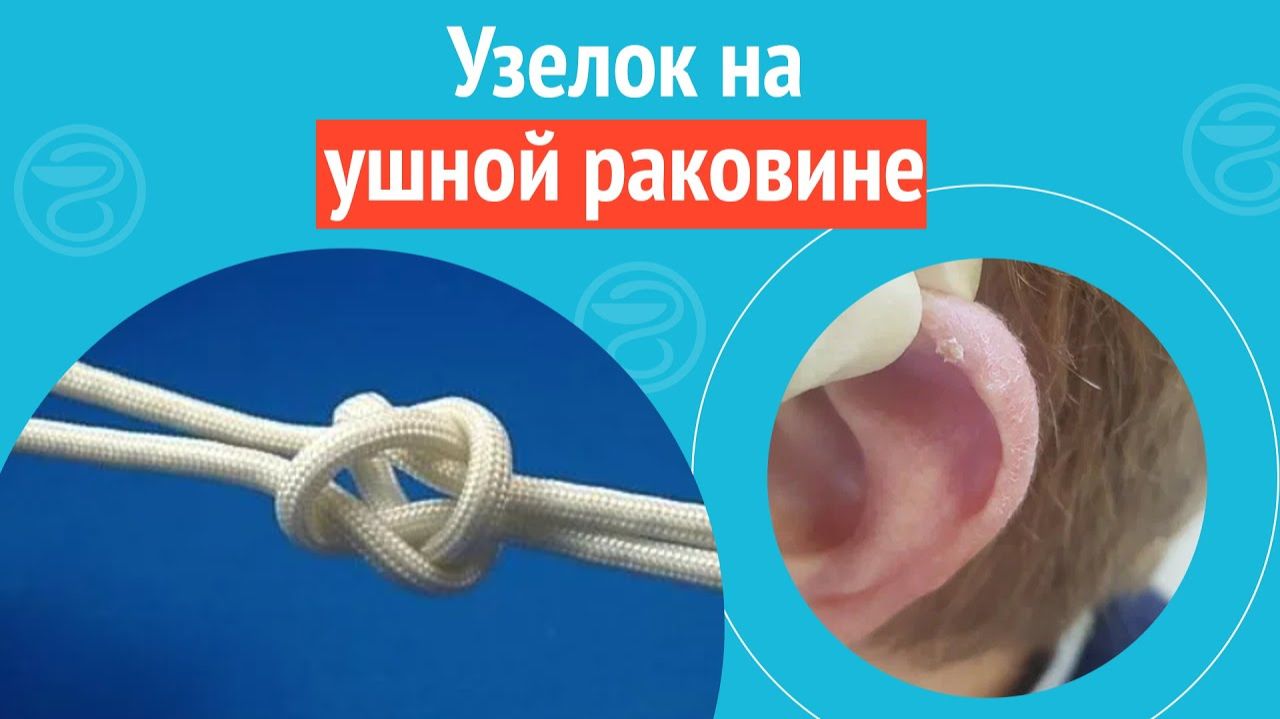 👂 Узелок на ушной раковине. Клинический случай №1272
